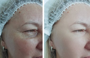 Yaşlı kadın tedavi öncesi ve sonrası kırışıklıklar