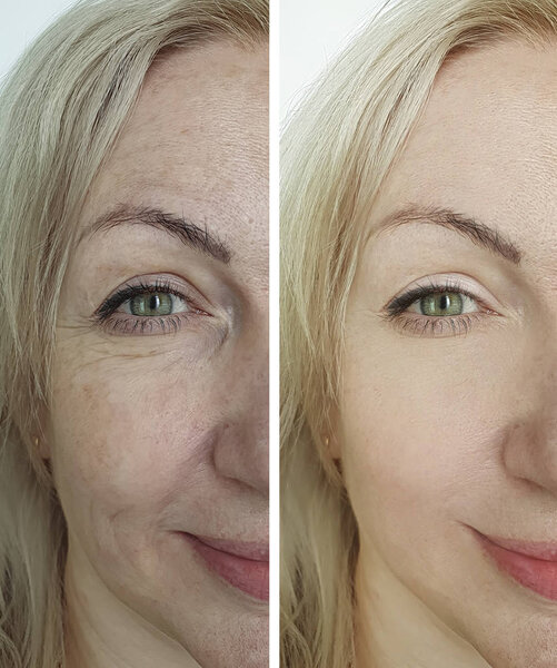 woman eyes wrinkles before and after treatment