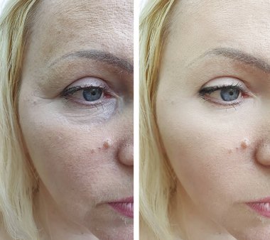 Kadın tedaviden önce ve sonra kırışıklıklarla karşılaşır