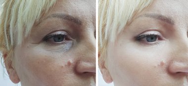 Kadın tedaviden önce ve sonra kırışıklıklarla karşılaşır