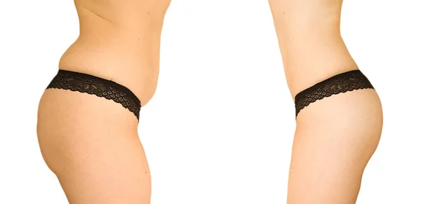 Woman Body Slimming Liposuction — Stock Photo, Image