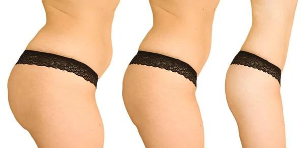 Emagrecimento Corpo Mulher Antes Depois Lipoaspiração — Fotografia de Stock