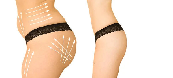 Emagrecimento Corpo Mulher Antes Depois Lipoaspiração — Fotografia de Stock