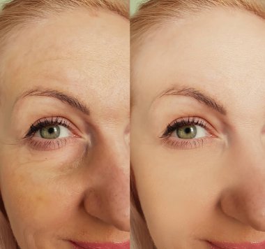 Kadınlar kolaj tedavisinden önce ve sonra kırışıklıklarla karşılaşırlar.