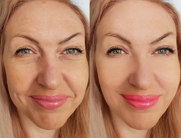 Woman Face Wrinkles Collage Treatment — Stock Photo, Image