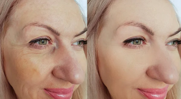 コラージュ前と後の女性の顔のしわ治療 — ストック写真
