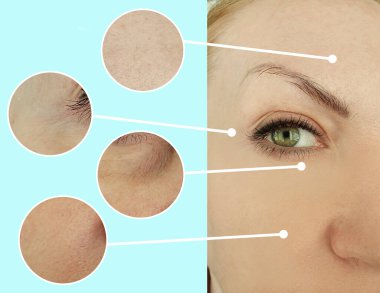 Kadınlar kolaj tedavisinden önce ve sonra kırışıklıklarla karşılaşırlar.