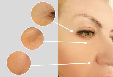 Kadınlar kolaj tedavisinden önce ve sonra kırışıklıklarla karşılaşırlar.