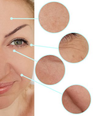 Kadınlar kolaj tedavisinden önce ve sonra kırışıklıklarla karşılaşırlar.