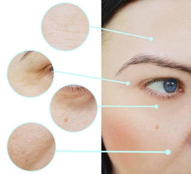 Kadınlar kolaj tedavisinden önce ve sonra kırışıklıklarla karşılaşırlar.