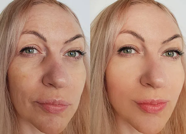Woman Face Wrinkles Treatment Collage — Stock Photo, Image