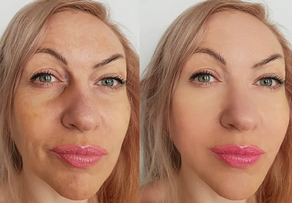 Arrugas Cara Mujer Antes Después Del Tratamiento Collage — Foto de Stock