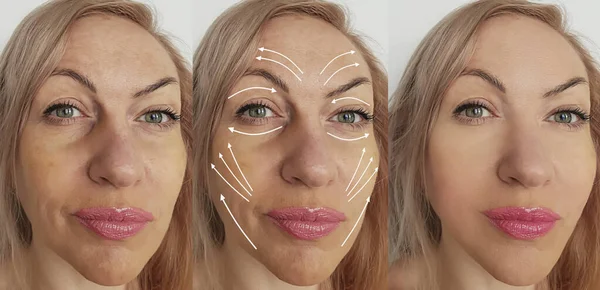 Arrugas Cara Mujer Antes Después Del Tratamiento Flecha — Foto de Stock