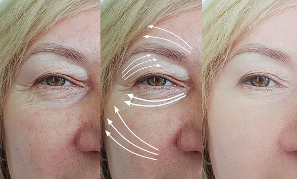 Wanita Wajah Keriput Sebelum Dan Setelah Pengobatan Panah — Stok Foto