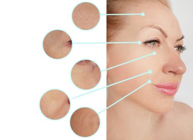 Kadın tedavi öncesi ve sonrası kırışıklıklarla karşılaşır.