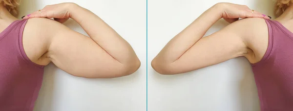 Θηλυκό Χέρι Πριν Και Μετά Την Απώλεια Βάρους — Φωτογραφία Αρχείου