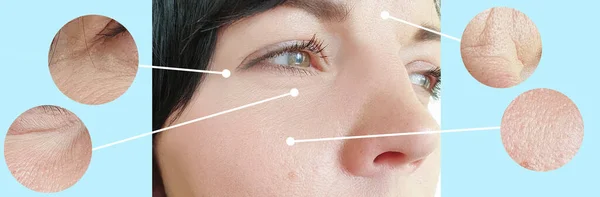 Arrugas Faciales Mujer Antes Después Del Tratamiento Del Collage — Foto de Stock