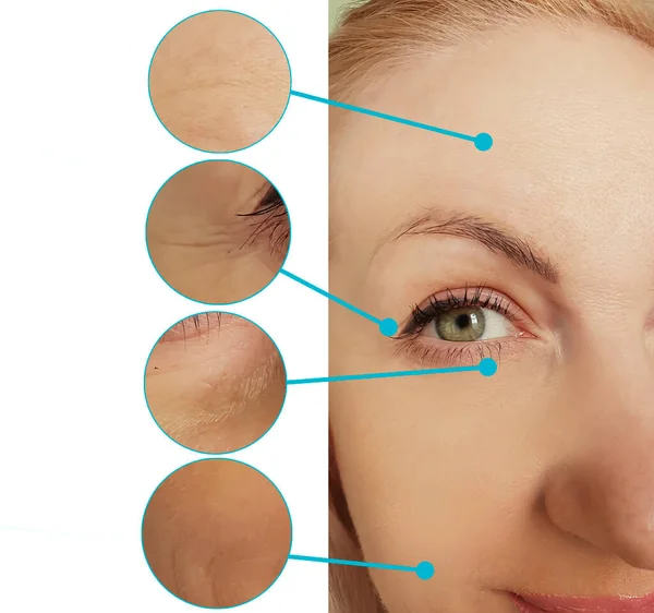  Kadınlar kolaj tedavisinden önce ve sonra kırışıklıklarla karşılaşırlar.