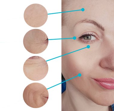  Kadınlar kolaj tedavisinden önce ve sonra kırışıklıklarla karşılaşırlar.