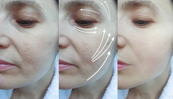 Arrugas Faciales Mujer Antes Después Del Tratamiento Del Collage — Foto de Stock