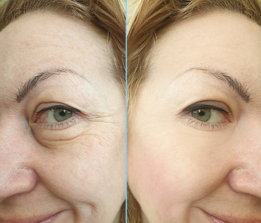 Kadınlar kolaj tedavisinden önce ve sonra kırışıklıklarla karşılaşırlar.