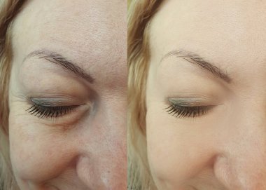 Kadınlar kolaj tedavisinden önce ve sonra kırışıklıklarla karşılaşırlar.