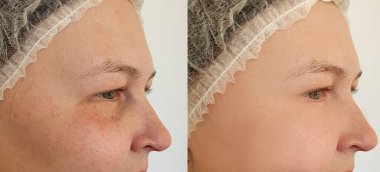 Kadın tedaviden önce ve sonra kırışıklıklarla karşılaşır.