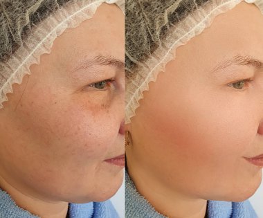 Kadın tedaviden önce ve sonra kırışıklıklarla karşılaşır.