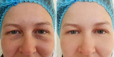 Kadın tedaviden önce ve sonra kırışıklıklarla karşılaşır.