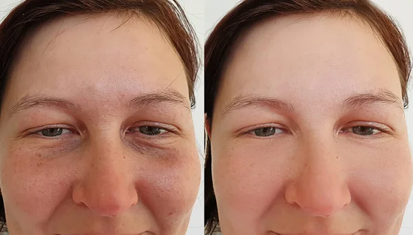 Wanita Wajah Keriput Sebelum Dan Setelah Pengobatan Kolase — Stok Foto