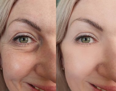 Kadın tedaviden önce ve sonra kırışıklıklarla karşılaşır.