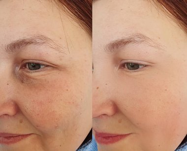 Kadın tedaviden önce ve sonra kırışıklıklarla karşılaşır.