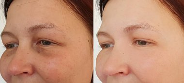 Kadın tedaviden önce ve sonra kırışıklıklarla karşılaşır.