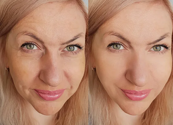 Wanita Wajah Keriput Sebelum Dan Setelah Pengobatan Kolase — Stok Foto