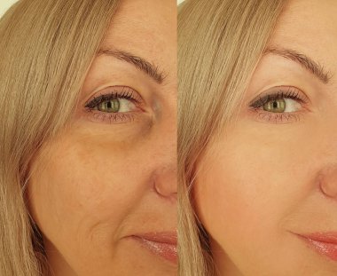 Kadın tedavi öncesi ve sonrası kırışıklıklarla karşılaşır.