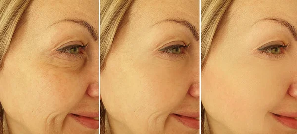Arrugas Cara Mujer Antes Después Del Tratamiento Collage —  Fotos de Stock