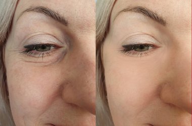 Kadın tedaviden önce ve sonra kırışıklıklarla karşılaşır.