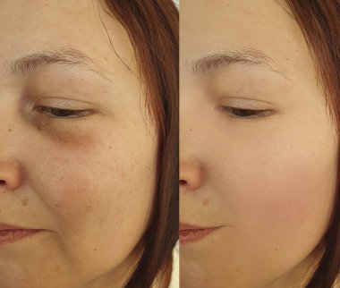 Kadın tedavi öncesi ve sonrası kırışıklıklarla karşılaşır.