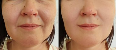 Kadın tedavi öncesi ve sonrası kırışıklıklarla karşılaşır.