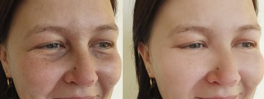 Kadın tedavi öncesi ve sonrası kırışıklıklarla karşılaşır.