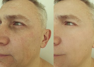  İnsan tedavi öncesi ve sonrası kırışıklıklarla yüzleşir