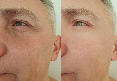 Adam tedavi öncesi ve sonrası kırışıklıklarla yüzleşiyor.