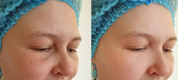 Kadın tedavi öncesi ve sonrası kırışıklıklarla karşılaşır.