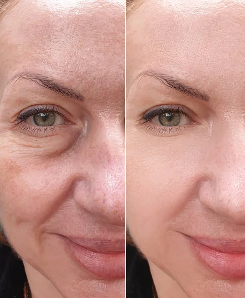 Female Face Wrinkles Treatment Collage — Stock Photo, Image