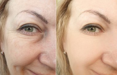 Kadın yüz kırışıklıkları tedavi öncesi ve sonrası kolajı