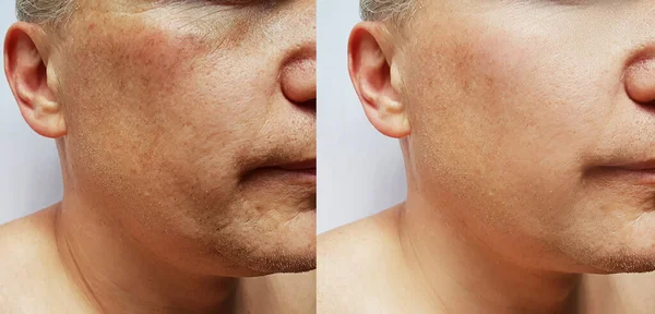 治療前と治療後の男性の顔のしわ — ストック写真