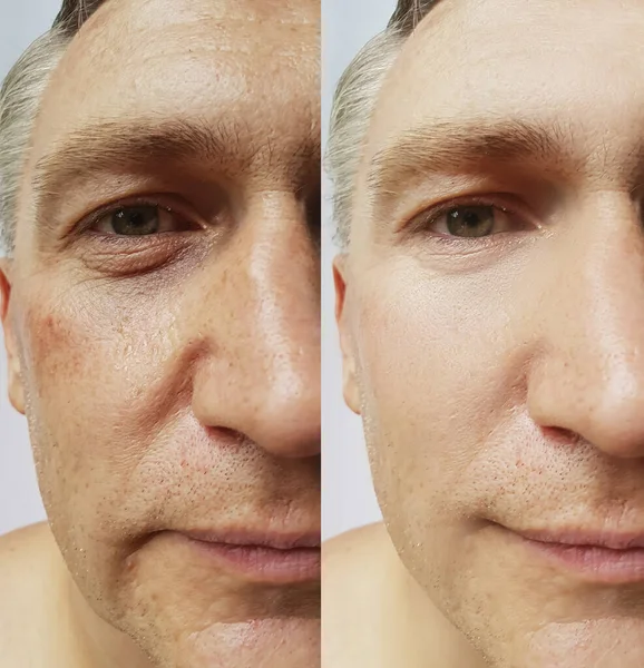 Mann Gesicht Falten Vor Und Nach Der Behandlung — Stockfoto