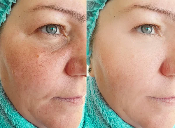 Arrugas Faciales Mujer Antes Después Del Tratamiento —  Fotos de Stock