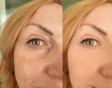 Kadın tedaviden önce ve sonra kırışıklıklarla karşılaşır