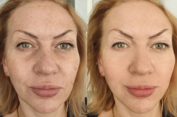 woman face wrinkles before and after treatment collage